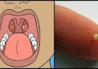 8 sinais de Pedras nas amígdalas que NUNCA devem ser ignorados